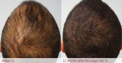 microneedling santa barbara